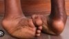 Kulabantwana abanengi ababelethwa belesimo seClubfoot elakho ukwenza bebelenyawo ezitshekileyo sebekhulile. 