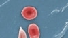 Kasashen Duniya Na Bikin Tunawa Da Ranar Yaki Da Cutar Amosani-Sickle Cell