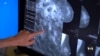 Does AI detect breast cancer better than doctors can?