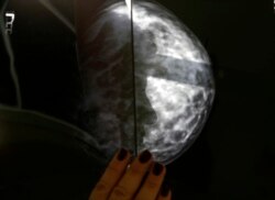 Seorang pasien kanker payudara Yunani menunjukkan hasil x-ray setelah pemeriksaan radiologis di sebuah rumah sakit. (Foto: REUTERS/Yannis Behrakis)