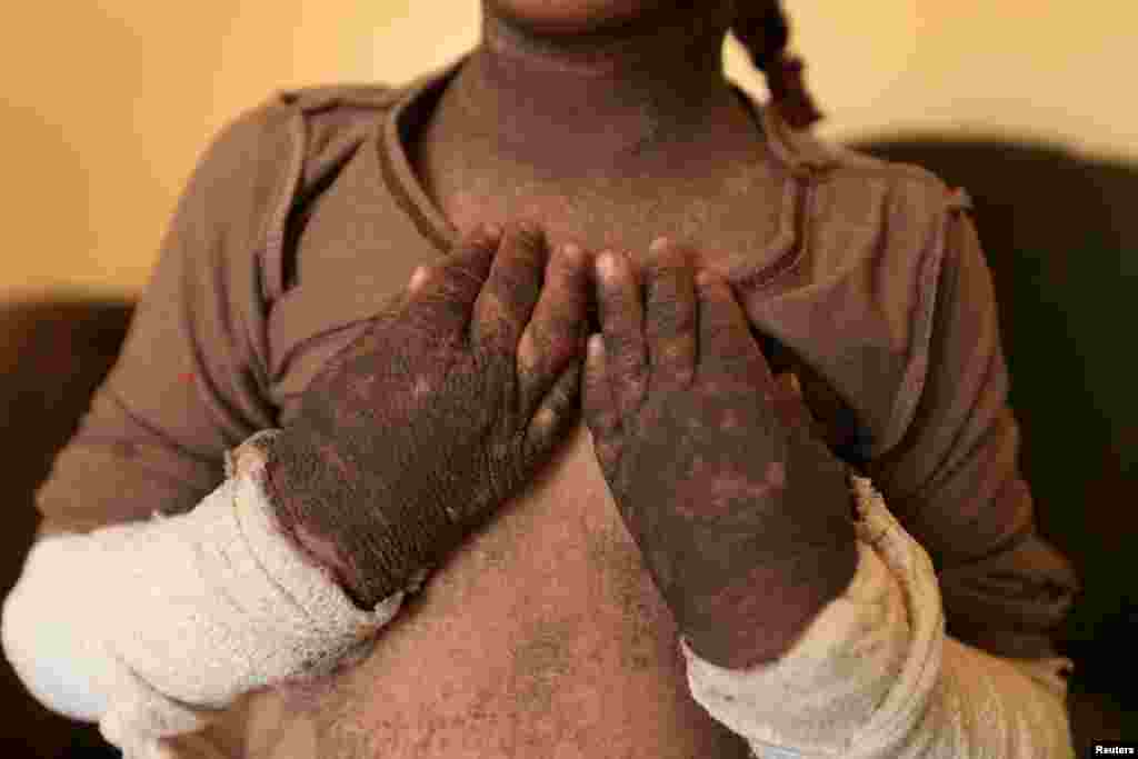 The skin on five-year-old Doaa's arms and neck is blackened after a rocket fired by Islamic State landed and exploded in Qayyara, Iraq, Nov. 12, 2016.