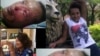 Meseret Nigusse after and before the accedent 