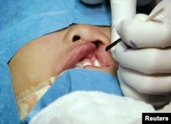 cleft lip