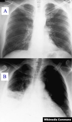 Sinar-X menunjukkan paru-paru yang bersih (A) dan paru-paru yang terinfeksi pneumonia (B)